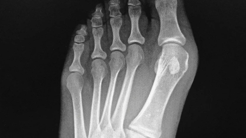 Bunion Surgery Recovery Timeline, Pain Management, and Rehabilitation Guide