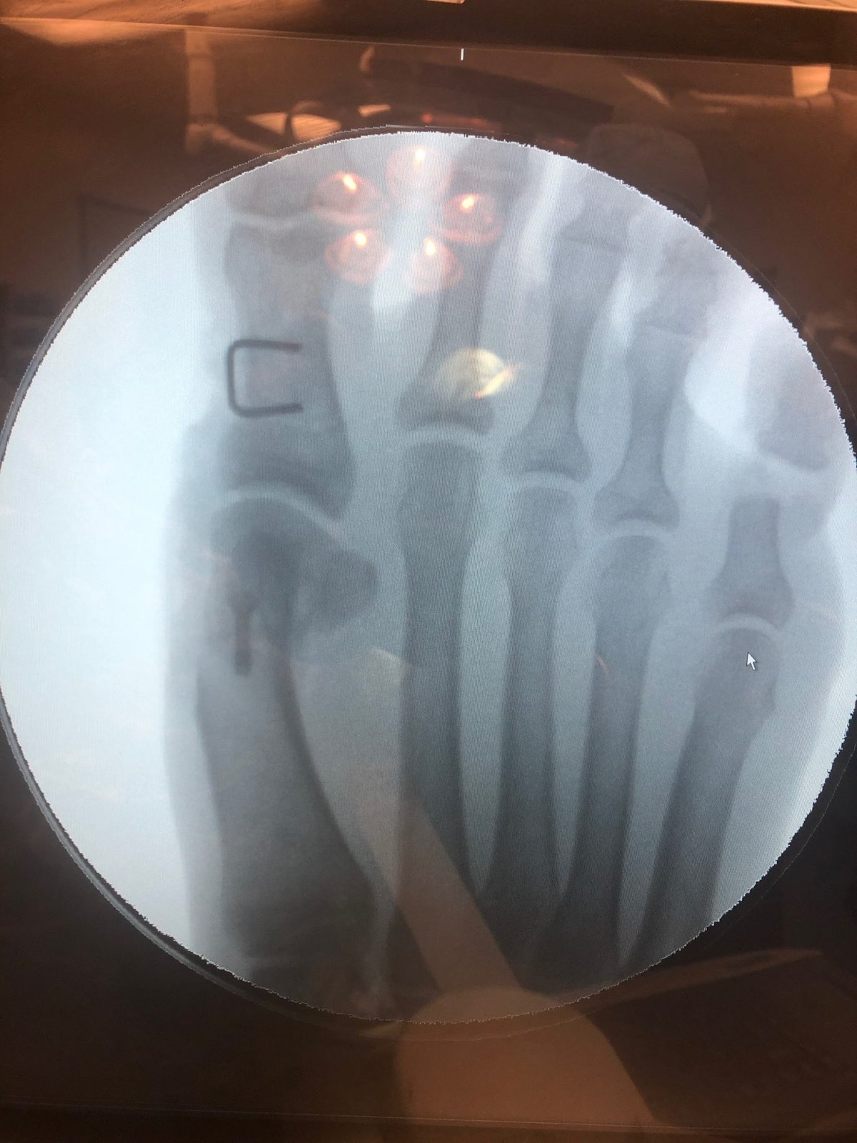 Is Bunion Surgery Worth It to End Your Chronic Foot Pain?