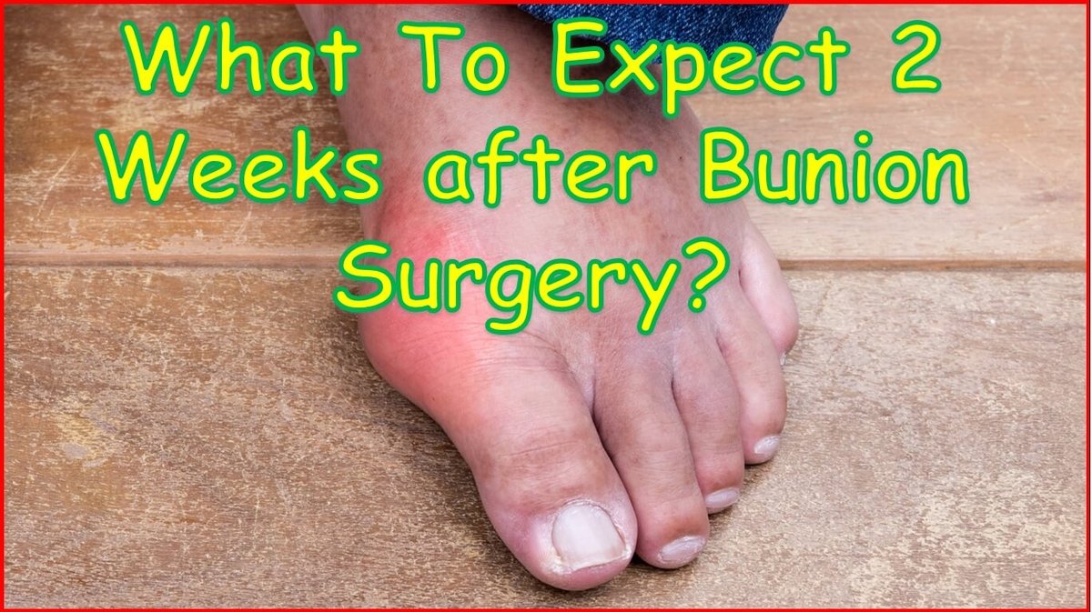 Choosing Types of Bunion Surgery & What to Expect